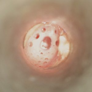 Otomicro_otite-media2