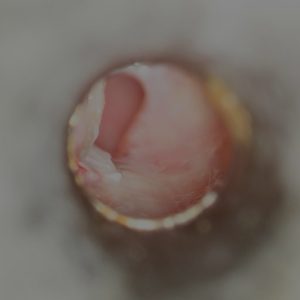 Otomicro_perforazione-1