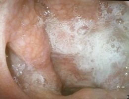 Rinosinusite3